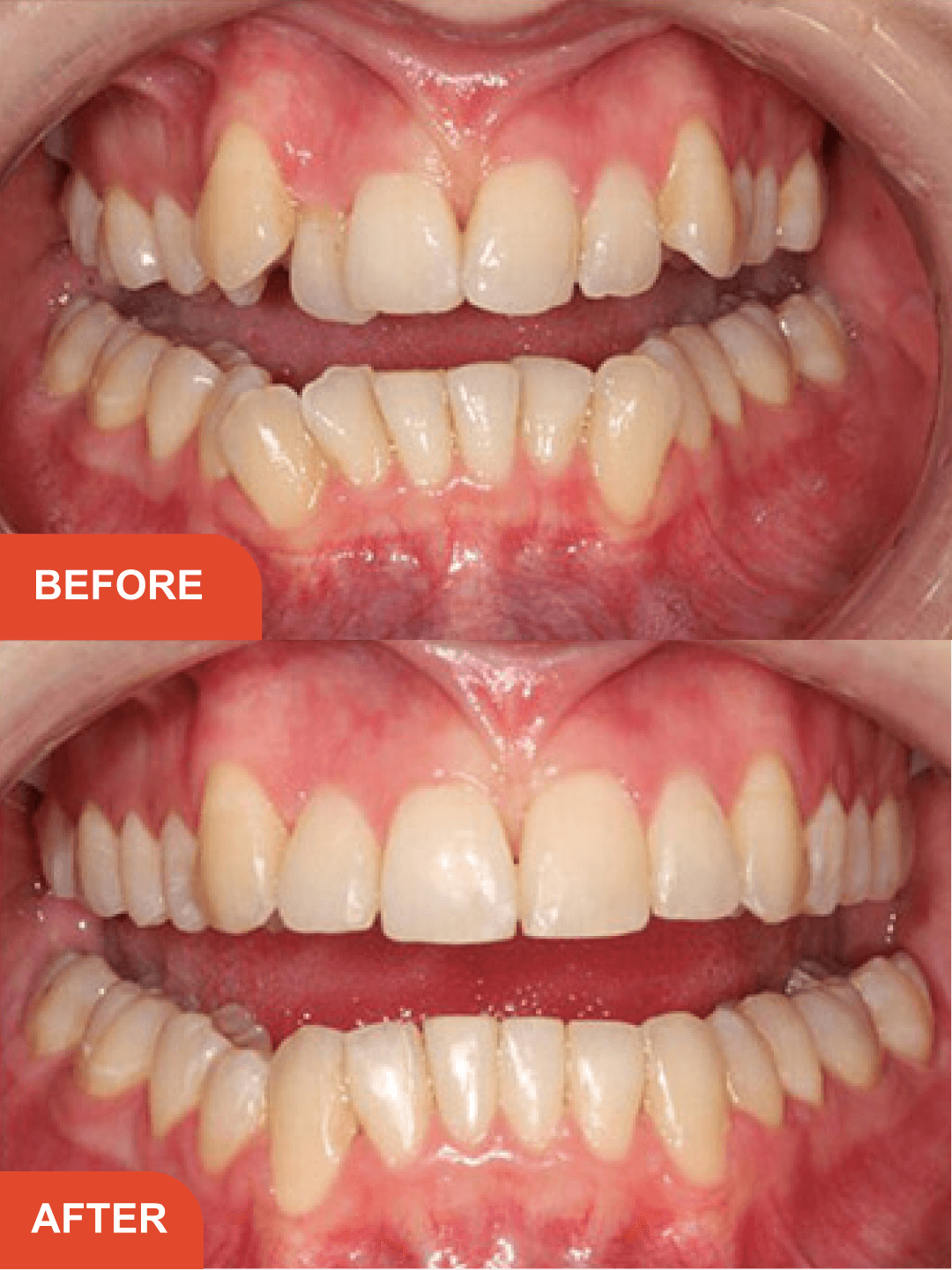 Before After Treatment