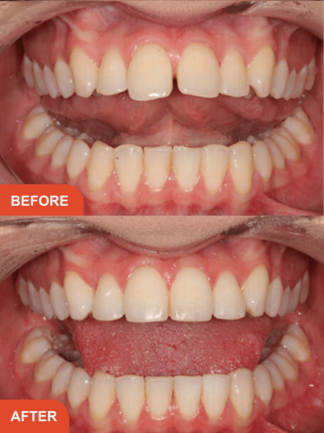 Before After Treatment