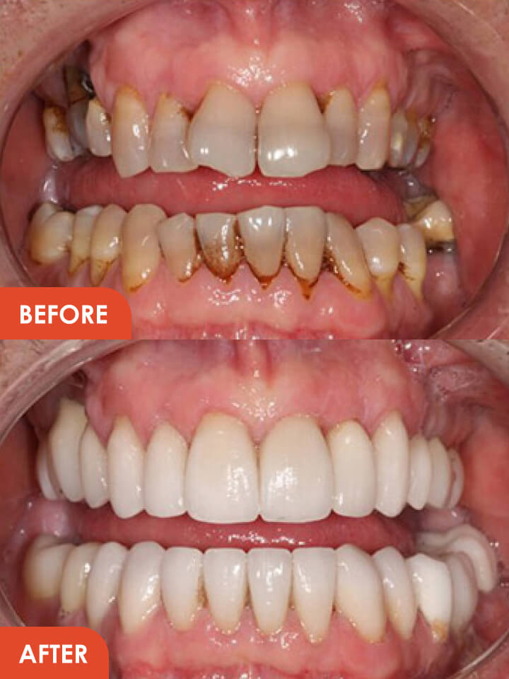 Smile Makeover Treatment Result Essex