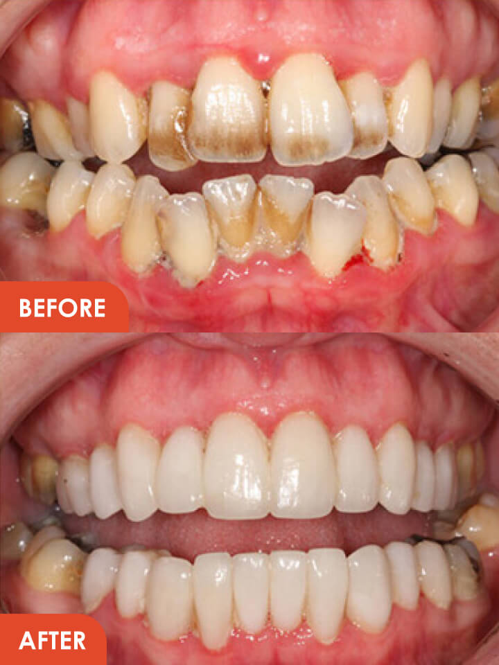 Smile Makeover Before After Image