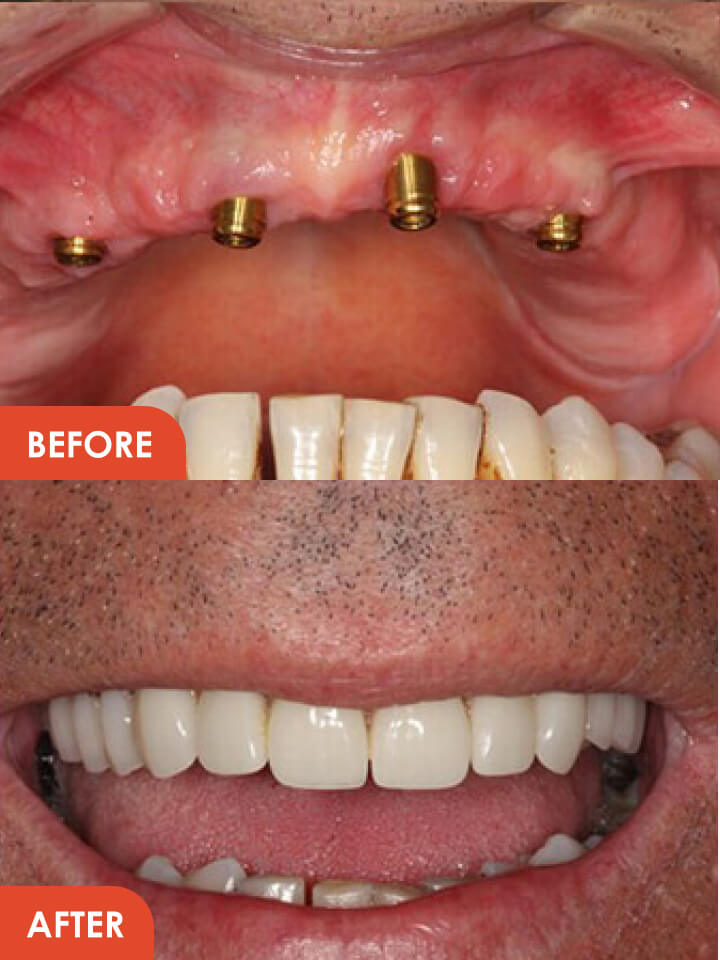 Smile Makeover Essex Before After