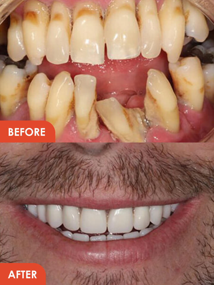 Smile Makeover Before After