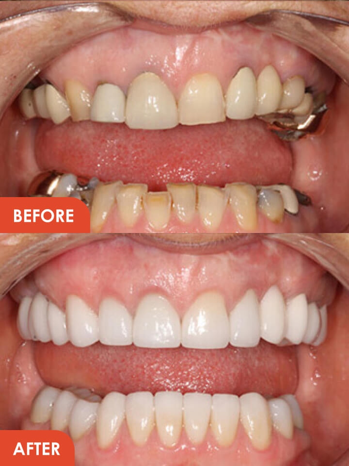 Smile Makeover Before After