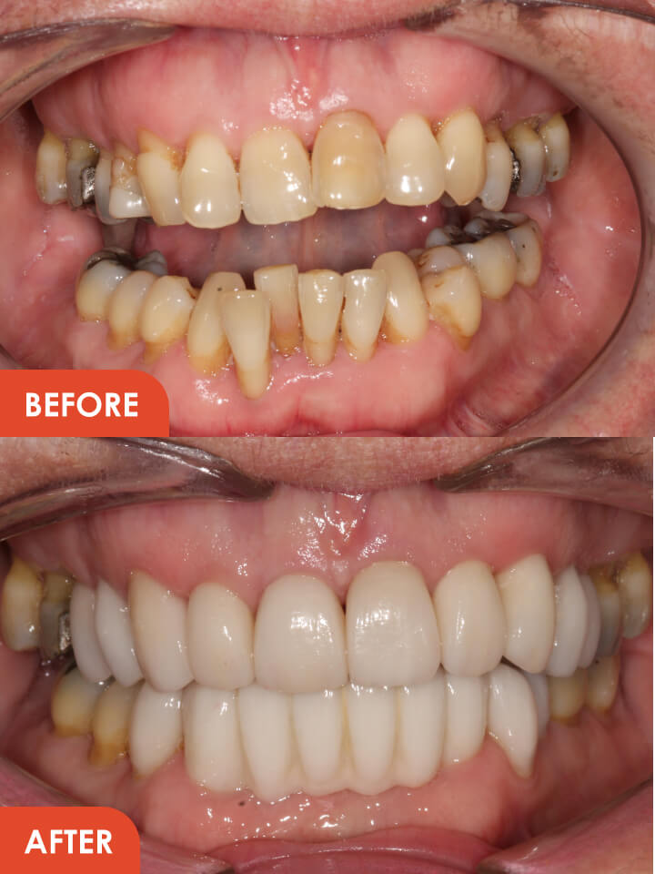 Smile Makeover Essex Before After