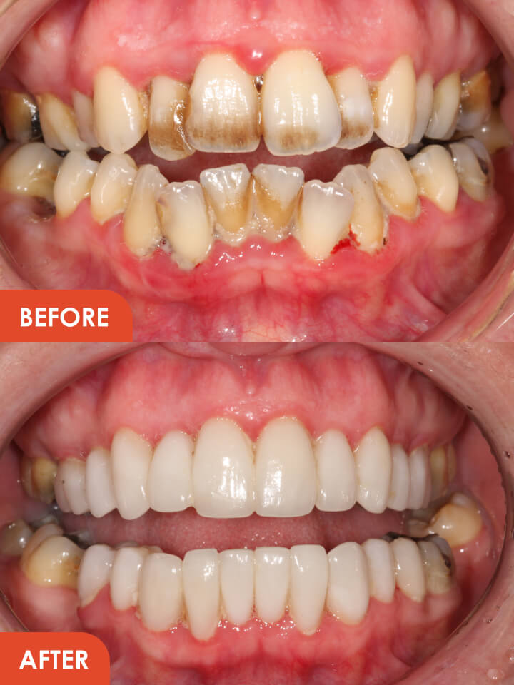 Smile Makeover Before After