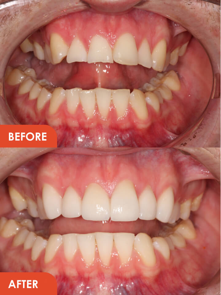 Smile Makeover Essex Before After