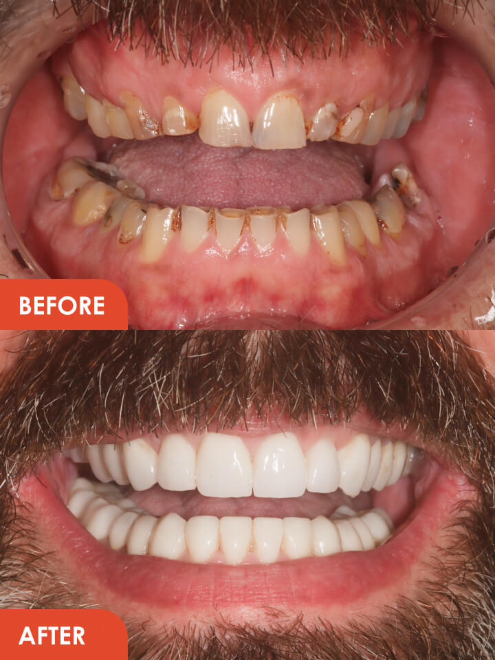 Smile Makeover Essex Before After