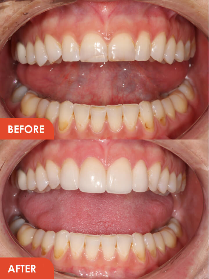 Smile Makeover Before After