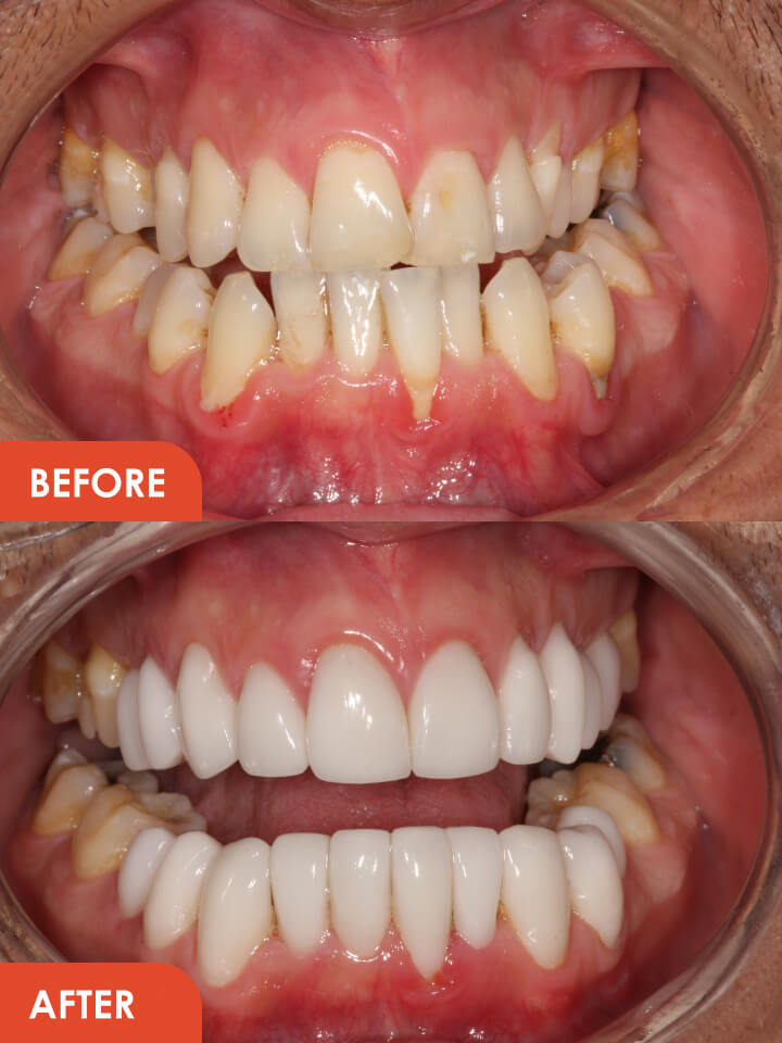 Smile Makeover Before After