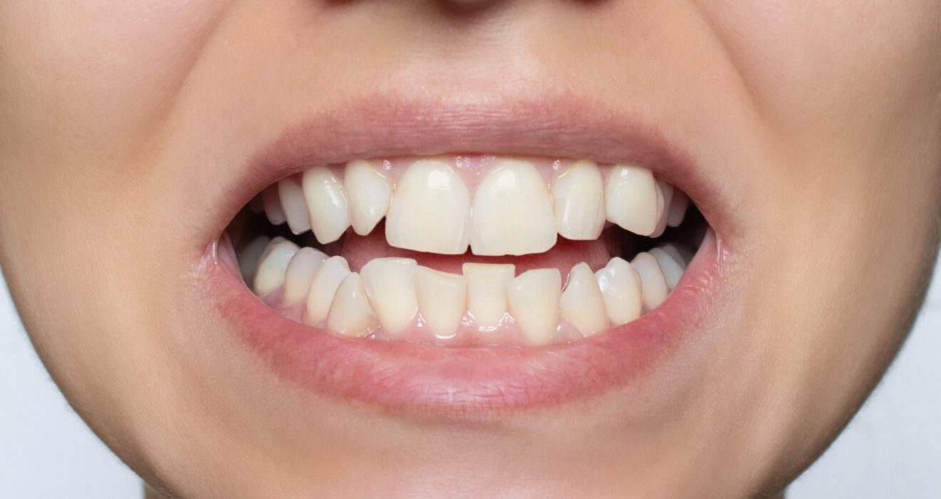 Crooked teeth dentist Essex