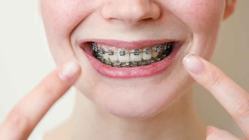 adult braces Essex