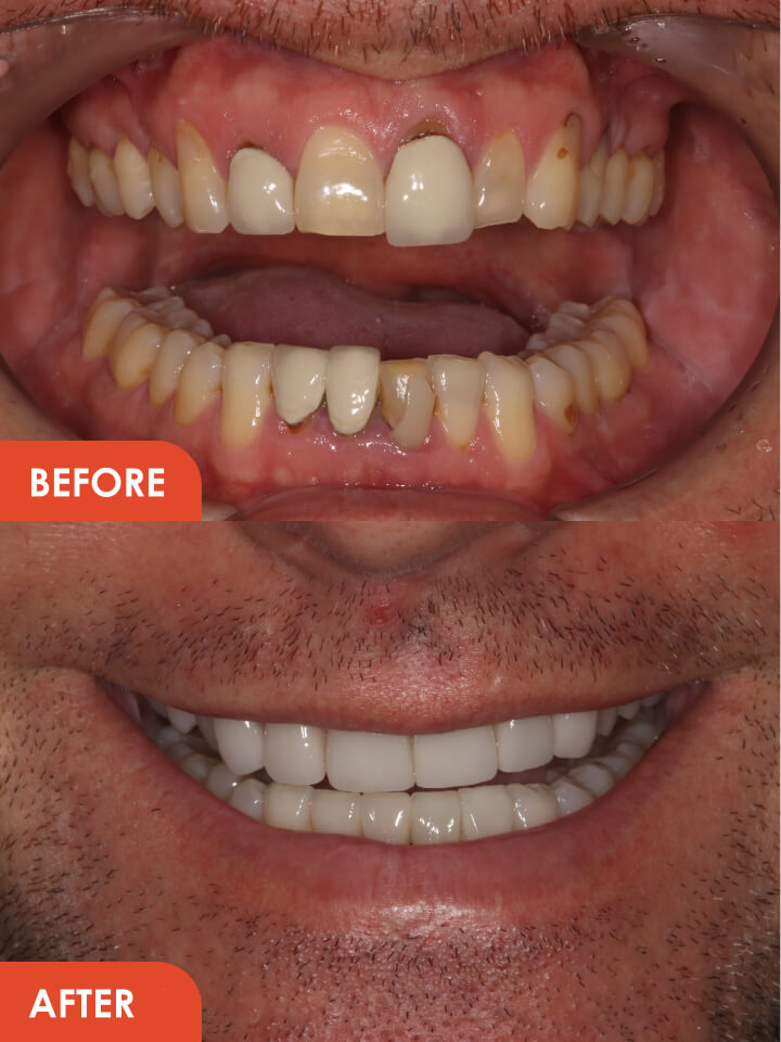 dental veneers in Essex 