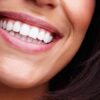 veneers in Essex