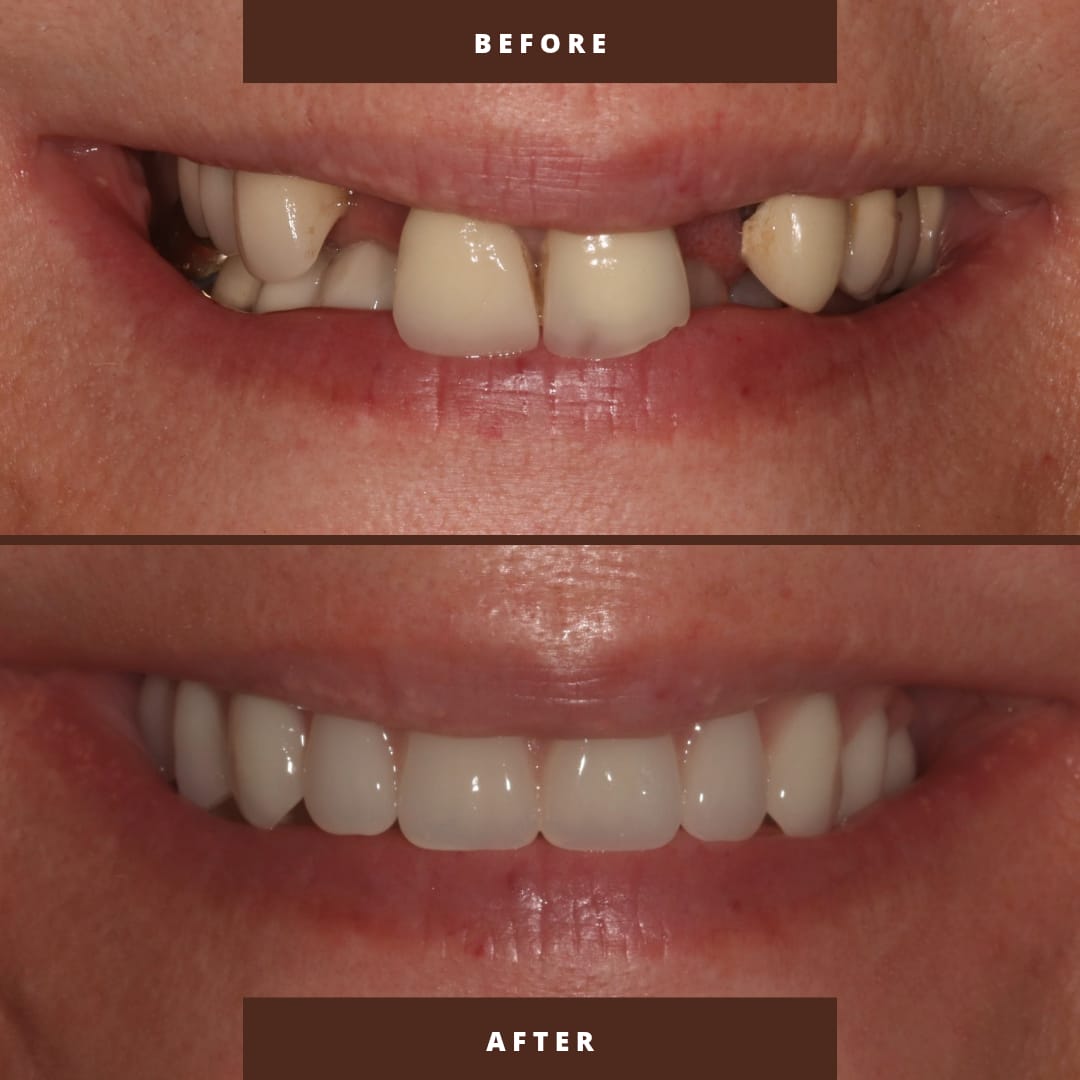 All on 4 Implants Essex