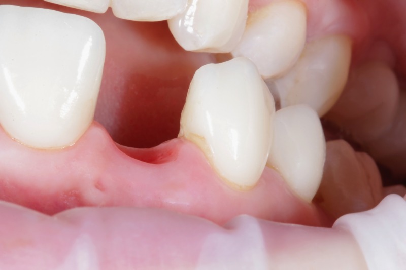 Dental implants in Essex