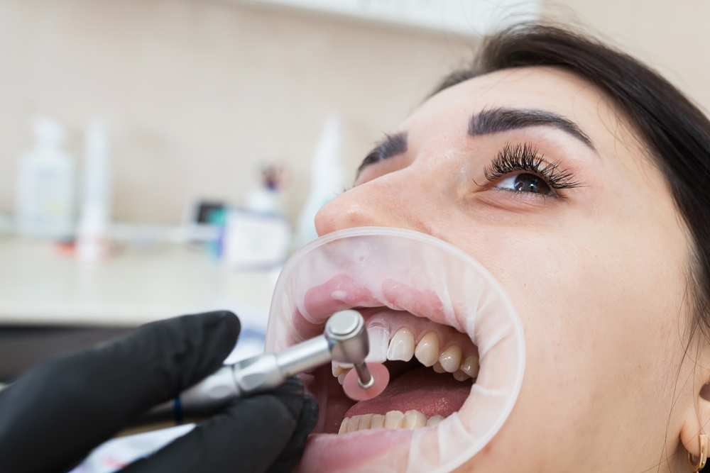 Dental veneers Essex