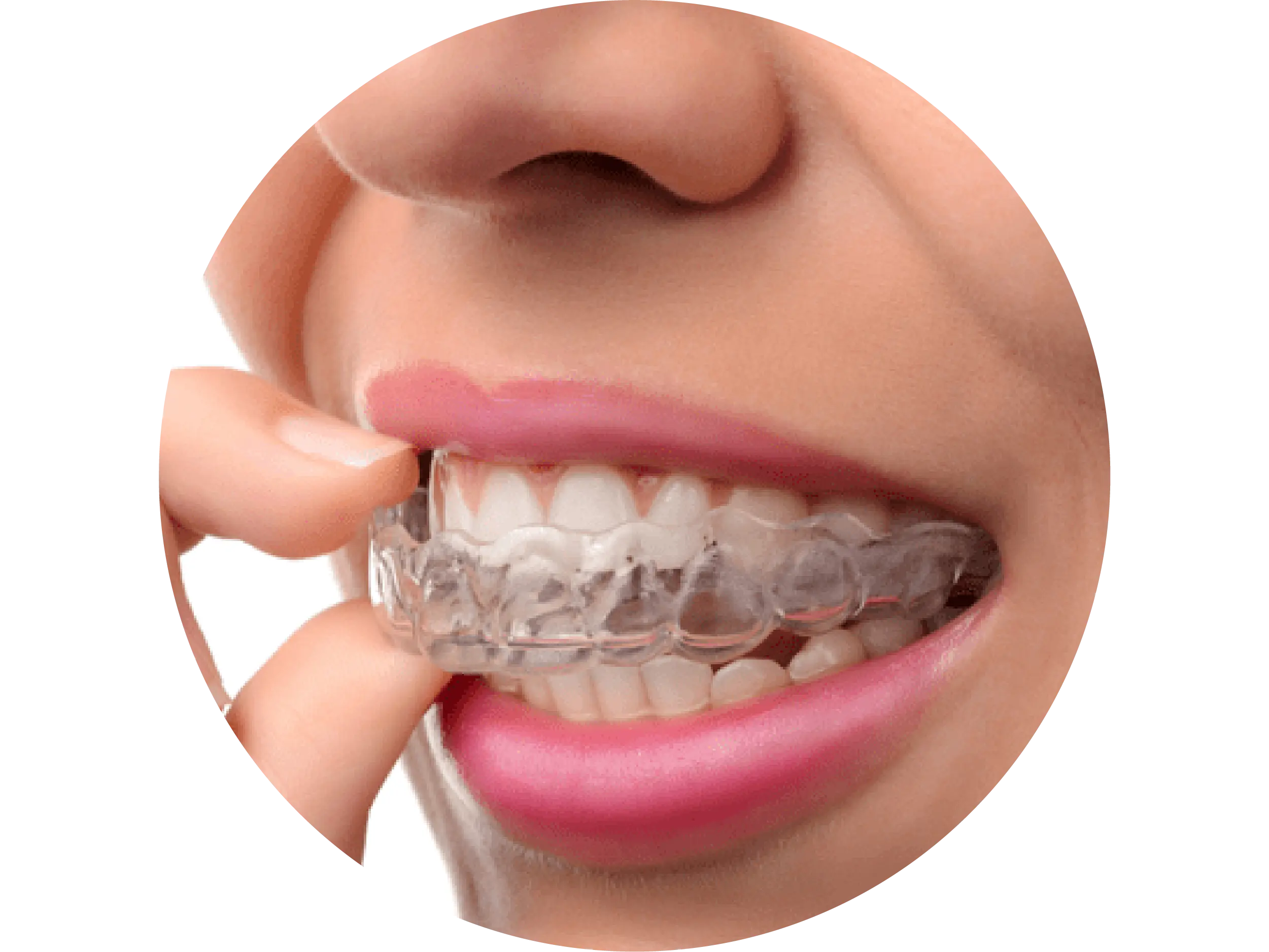 Invisalign aligners being added in 