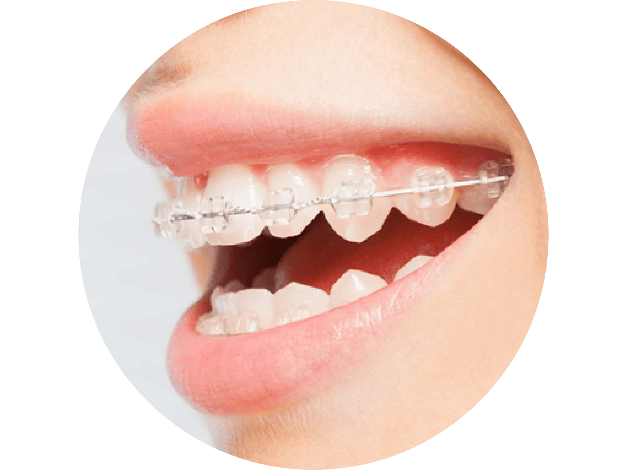 Six month smiles braces small