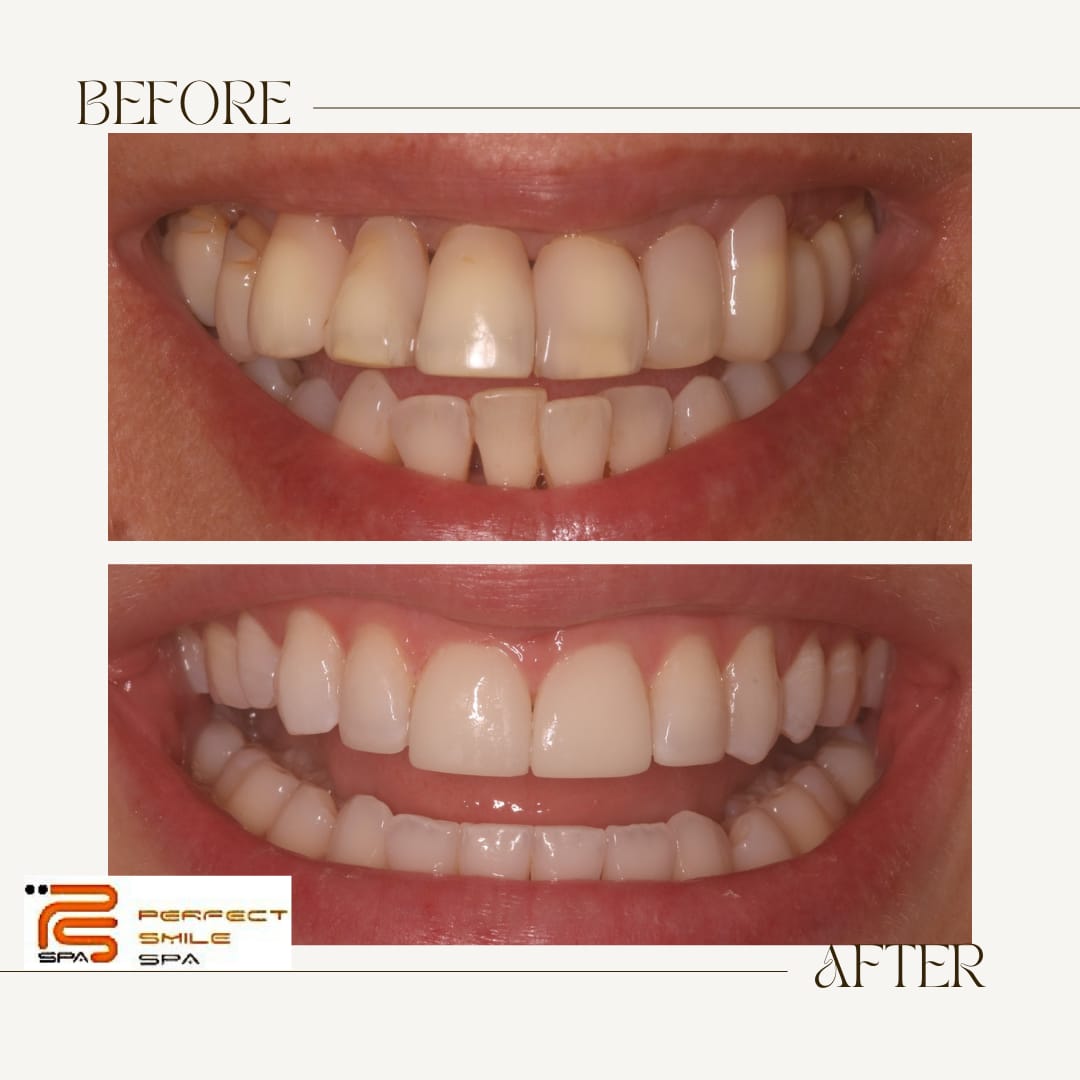 Composite bonding before and after