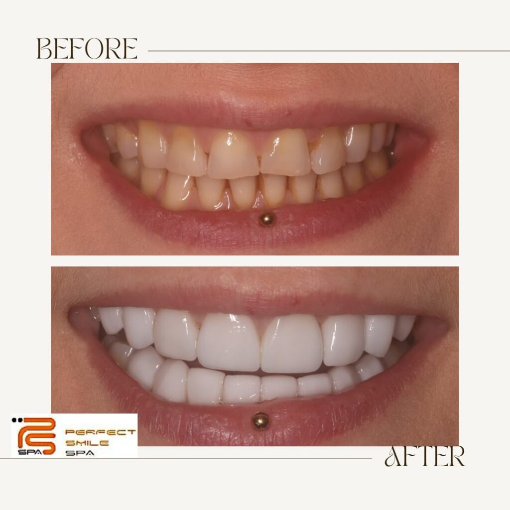 Dental veneers before and after Essex