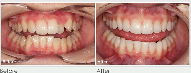 Teeth whitening Essex
