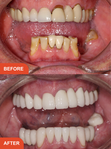 Before After Treatment