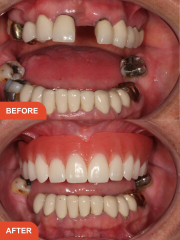 Before After Treatment