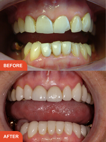 Mini Smile Makeover result - 2