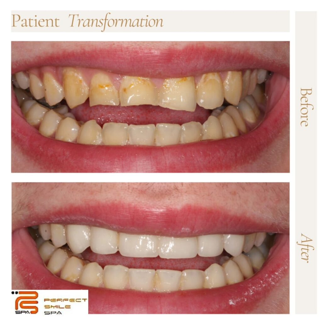 Dental wear before and after Essex