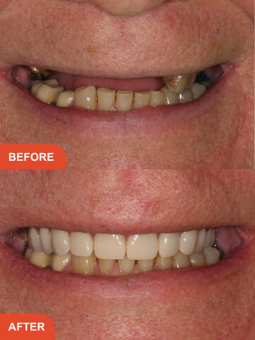 Before After Treatment