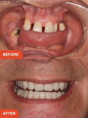 Before After Treatment