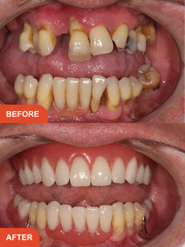 Before After Treatment