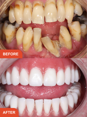 Before After Treatment