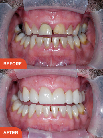 Mini Smile Makeover result - 3