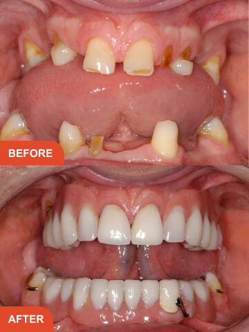 Mini Smile Makeover result - 1