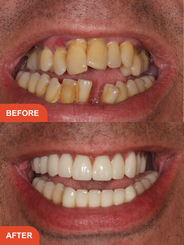 Before After Treatment