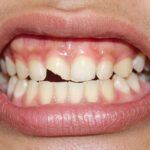 Close-up of chipped front tooth before treatment at Perfect Smile Spa, highlighting need for emergency dental care