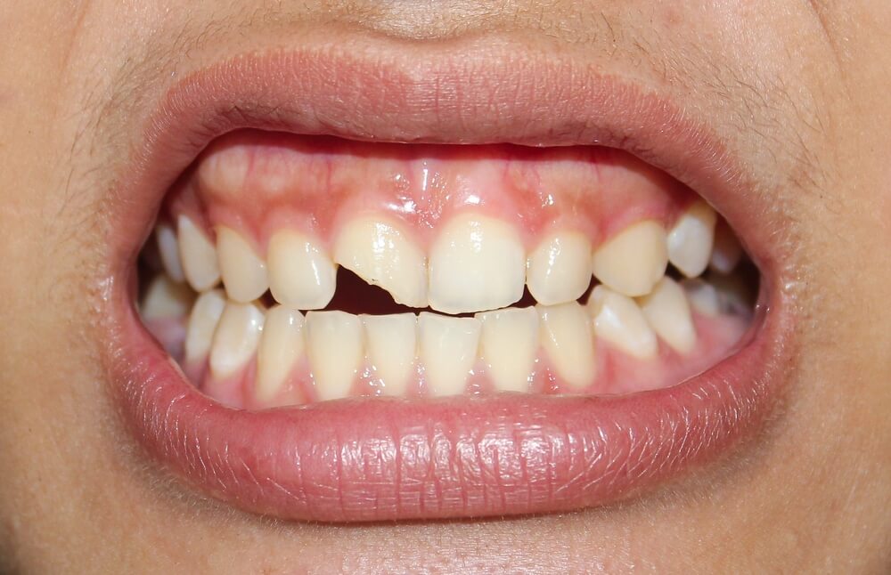 Close-up of chipped front tooth before treatment at Perfect Smile Spa, highlighting need for emergency dental care