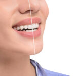 laser gum contouring at Perfect Smile Spa