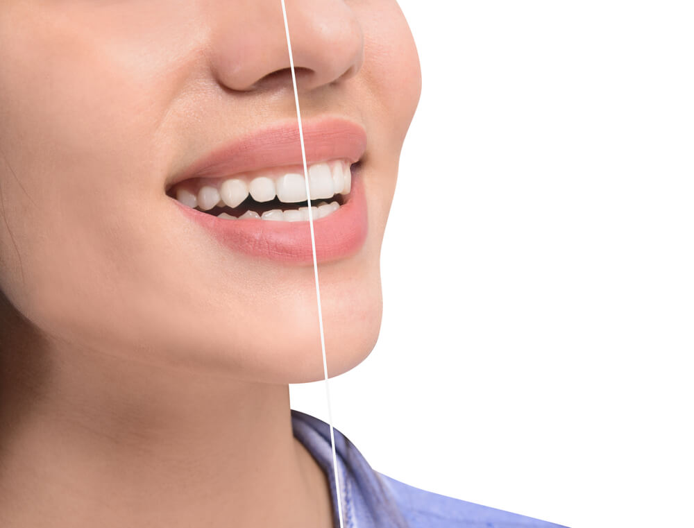 laser gum contouring at Perfect Smile Spa