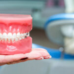 Tooth coloured braces