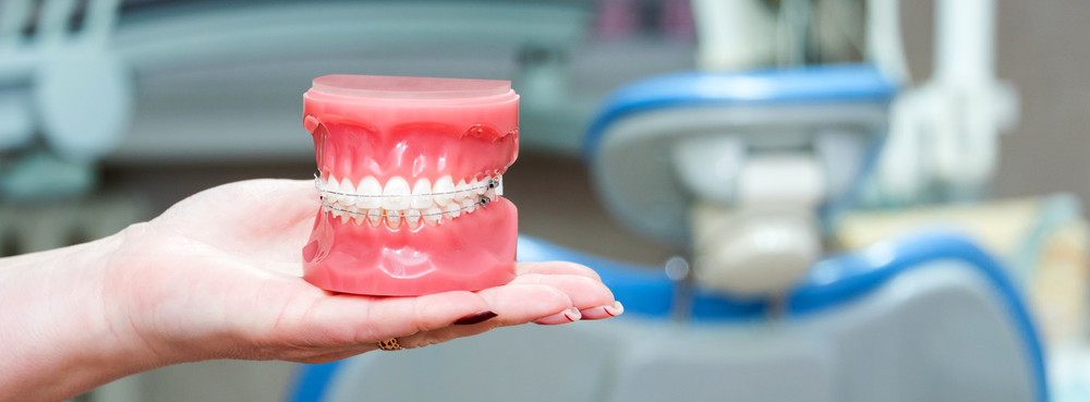 Tooth coloured braces