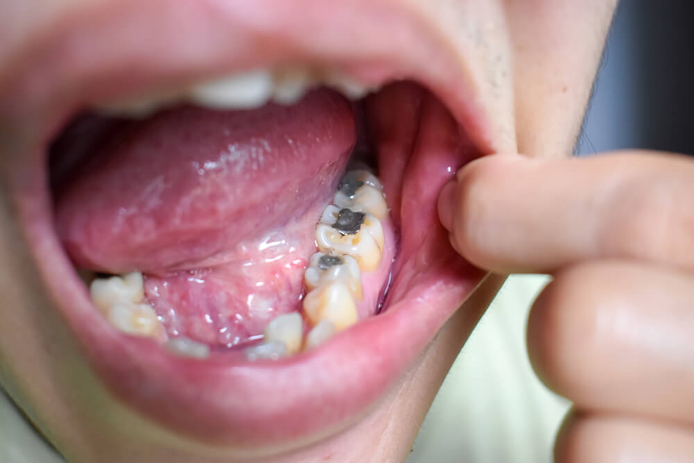 Say Goodbye to Amalgam Fillings