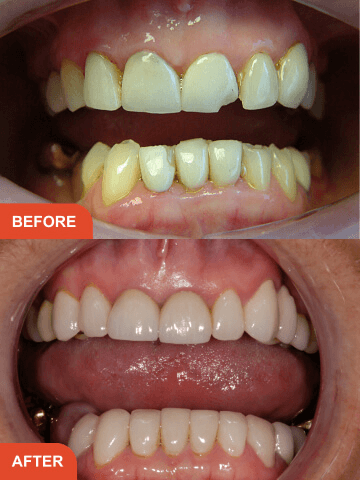 Smile makeover Essex