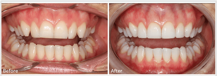 Teeth whitening Essex