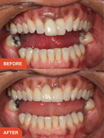 Allen Georgette Before After Treatment