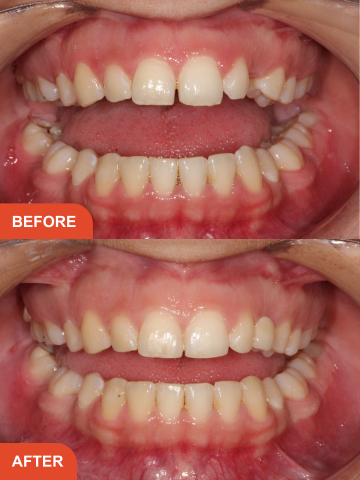 Bailie Bridgeman Before After Treatment