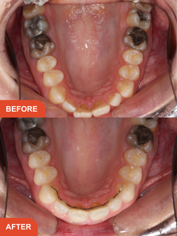 Before and after adult braces in Essex