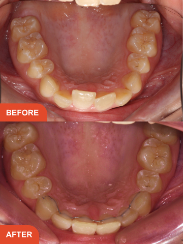 Before and after adult braces in Essex