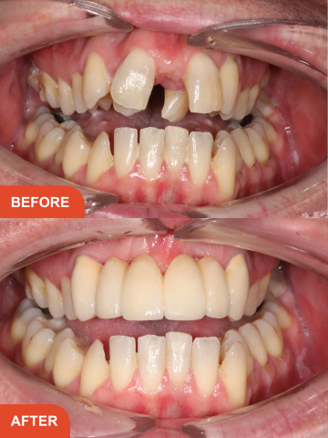 David Carter Before After Treatment